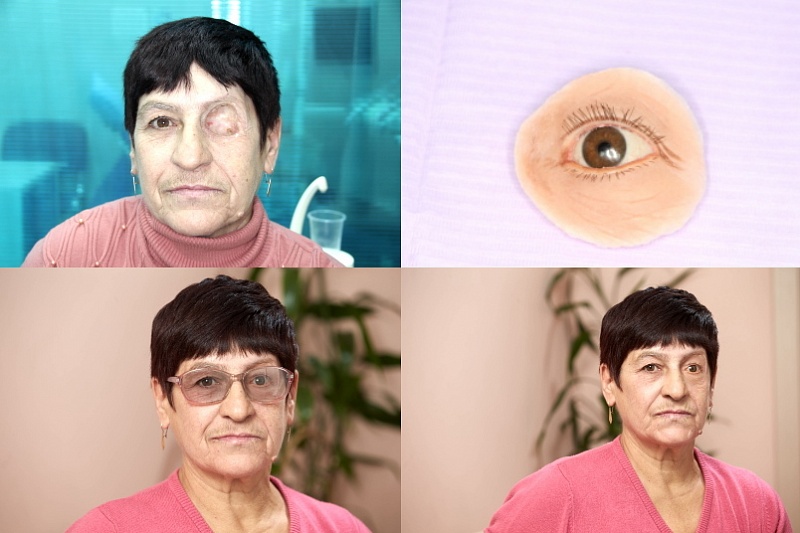 Эпитез глазницы